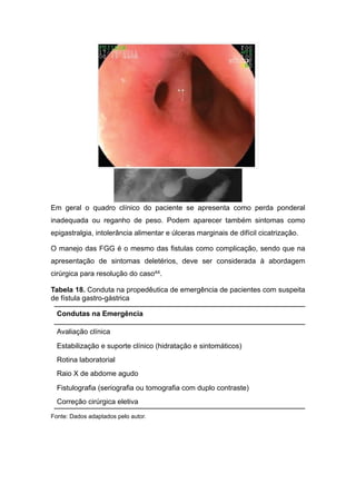 Em geral o quadro clínico do paciente se apresenta como perda ponderal
inadequada ou reganho de peso. Podem aparecer também sintomas como
epigastralgia, intolerância alimentar e úlceras marginais de difícil cicatrização.
O manejo das FGG é o mesmo das fistulas como complicação, sendo que na
apresentação de sintomas deletérios, deve ser considerada à abordagem
cirúrgica para resolução do caso44.
Tabela 18. Conduta na propedêutica de emergência de pacientes com suspeita
de fístula gastro-gástrica
Fonte: Dados adaptados pelo autor.
Condutas na Emergência
Avaliação clínica
Estabilização e suporte clínico (hidratação e sintomáticos)
Rotina laboratorial
Raio X de abdome agudo
Fistulografia (seriografia ou tomografia com duplo contraste)
Correção cirúrgica eletiva
 