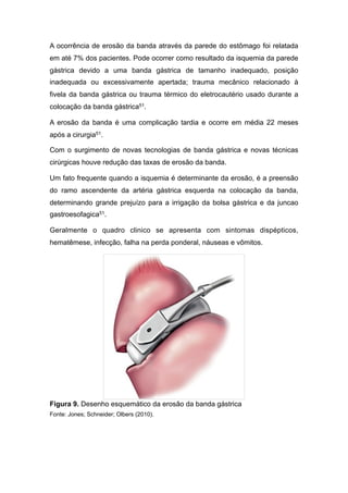 A ocorrência de erosão da banda através da parede do estômago foi relatada
em até 7% dos pacientes. Pode ocorrer como resultado da isquemia da parede
gástrica devido a uma banda gástrica de tamanho inadequado, posição
inadequada ou excessivamente apertada; trauma mecânico relacionado à
fivela da banda gástrica ou trauma térmico do eletrocautério usado durante a
colocação da banda gástrica51.
A erosão da banda é uma complicação tardia e ocorre em média 22 meses
após a cirurgia51.
Com o surgimento de novas tecnologias de banda gástrica e novas técnicas
cirúrgicas houve redução das taxas de erosão da banda.
Um fato frequente quando a isquemia é determinante da erosão, é a preensão
do ramo ascendente da artéria gástrica esquerda na colocação da banda,
determinando grande prejuízo para a irrigação da bolsa gástrica e da juncao
gastroesofagica51.
Geralmente o quadro clinico se apresenta com sintomas dispépticos,
hematêmese, infecção, falha na perda ponderal, náuseas e vômitos.
Figura 9. Desenho esquemático da erosão da banda gástrica
Fonte: Jones; Schneider; Olbers (2010).
 