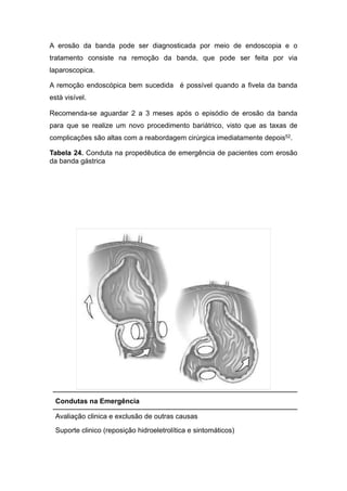 A erosão da banda pode ser diagnosticada por meio de endoscopia e o
tratamento consiste na remoção da banda, que pode ser feita por via
laparoscopica.
A remoção endoscópica bem sucedida é possível quando a fivela da banda
està visível.
Recomenda-se aguardar 2 a 3 meses após o episódio de erosão da banda
para que se realize um novo procedimento bariátrico, visto que as taxas de
complicações são altas com a reabordagem cirúrgica imediatamente depois52.
Tabela 24. Conduta na propedêutica de emergência de pacientes com erosão
da banda gástrica
Condutas na Emergência
Avaliação clinica e exclusão de outras causas
Suporte clinico (reposição hidroeletrolítica e sintomáticos)
 