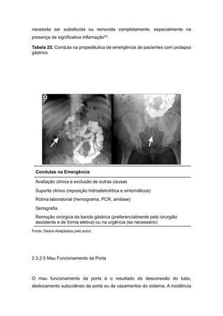necessita ser substituída ou removida completamente, especialmente na
presença de significativa inflamação53.
Tabela 25. Conduta na propedêutica de emergência de pacientes com prolapso
gástrico
Fonte: Dados Adaptados pelo autor.
2.3.2.5 Mau Funcionamento da Porta
O mau funcionamento da porta é o resultado da desconexão do tubo,
deslocamento subcutâneo da porta ou de vazamentos do sistema. A incidência
Condutas na Emergência
Avaliação clinica e exclusão de outras causas
Suporte clinico (reposição hidroeletrolítica e sintomáticos)
Rotina laboratorial (hemograma, PCR, amilase)
Seriografia
Remoção cirúrgica da banda gástrica (preferencialmente pelo cirurgião
assistente e de forma eletiva) ou na urgência (se necessário)
 