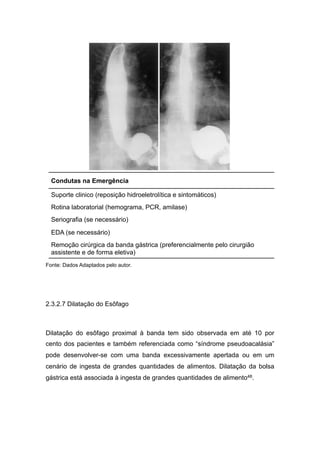 Fonte: Dados Adaptados pelo autor.
2.3.2.7 Dilatação do Esôfago
Dilatação do esôfago proximal à banda tem sido observada em até 10 por
cento dos pacientes e também referenciada como “síndrome pseudoacalásia”
pode desenvolver-se com uma banda excessivamente apertada ou em um
cenário de ingesta de grandes quantidades de alimentos. Dilatação da bolsa
gástrica está associada à ingesta de grandes quantidades de alimento48.
Suporte clinico (reposição hidroeletrolítica e sintomáticos)
Rotina laboratorial (hemograma, PCR, amilase)
Seriografia (se necessário)
EDA (se necessário)
Remoção cirúrgica da banda gástrica (preferencialmente pelo cirurgião
assistente e de forma eletiva)
Condutas na Emergência
 