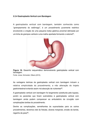 2.3.4 Gastroplastia Vertical com Bandagem
A gastroplastia vertical com bandagem, também conhecida como
“grampeamento do estômago”, é um procedimento puramente restritivo
envolvendo a criação de uma pequena bolsa gástrica proximal delineada por
um linha de grampos vertical e uma malha apertada formando o estoma60.
Figura 16. Desenho esquemático demonstrando gastroplastia vertical com
bandagem.
Fonte: Jones; Schneider; Olbers (2010).
As vantagens teóricas da gastroplastia vertical com bandagem incluem a
relativa simplicidade do procedimento, a não alteração do trajeto
gastrointestinal evitando assim má absorção de nutrientes60.
A gastroplastia vertical com bandagem foi largamente substituída pelo bypass,
porém os pacientes que foram submetidos à gastroplastia vertical com
bandagem ainda podem comparecer ao ambulatório da cirurgião com
complicações tardias do procedimento.
Dentre as complicações, semelhantes às supracitadas para os outros
procedimentos, devemos citar às fístulas, úlceras marginais, erosão da banda,
reganho de peso60.
 