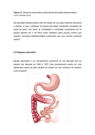 Figura 17. Desenho esquemático evidenciando derivação biliopancreática
Fonte: UpToDate (2016).
Na derivação biliopancreática não há criação de uma alça intestinal desviando
o trânsito, e isso a distingue do bypass jejunoileal. Excelentes resultados de
perda de peso, com taxas de mortalidade e morbidade comparáveis às do
bypass gástrico em Y de Roux foram relatados pelos poucos centros que
realizam derivação bibliopancreática juntamente com sua variante duodenal
switch73.
2.3.6 Bypass Jejunoileal
Bypass jejunoileal é um procedimento puramente de má absorção que foi
popular nas décadas de 1960 e 1970. Este procedimento resulta em uma
significativa perda de peso através da criação de uma síndrome do intestino
curto cirúrgica62.
 