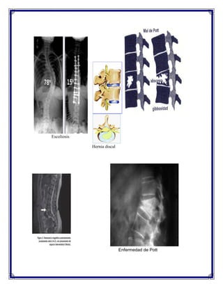 Escoliosis

             Hernia discal




                             Enfermedad de Pott
 