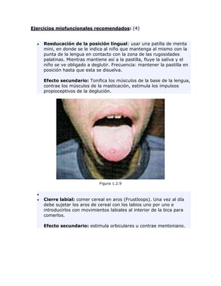 Ejercicios miofuncionales recomendados: (4)
Reeducación de la posición lingual: usar una patilla de menta
mini, en donde se le indica al niño que mantenga al mismo con la
punta de la lengua en contacto con la zona de las rugosidades
palatinas. Mientras mantiene así a la pastilla, fluye la saliva y el
niño se ve obligado a deglutir. Frecuencia: mantener la pastilla en
posición hasta que esta se disuelva.
Efecto secundario: Tonifica los músculos de la base de la lengua,
contrae los músculos de la masticación, estimula los impulsos
propioceptivos de la deglución.
Figura 1.2.9
Cierre labial: comer cereal en aros (Frustloops). Una vez al día
debe sujetar los aros de cereal con los labios uno por uno e
introducirlos con movimientos labiales al interior de la bica para
comerlos.
Efecto secundario: estimula orbiculares u contrae mentoniano.
 