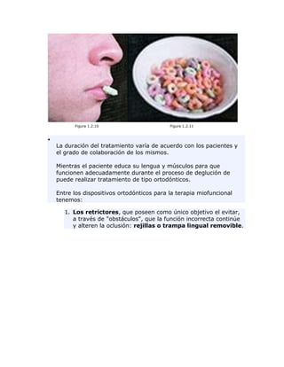 Figura 1.2.10 Figura 1.2.11
La duración del tratamiento varía de acuerdo con los pacientes y
el grado de colaboración de los mismos.
Mientras el paciente educa su lengua y músculos para que
funcionen adecuadamente durante el proceso de deglución de
puede realizar tratamiento de tipo ortodónticos.
Entre los dispositivos ortodónticos para la terapia miofuncional
tenemos:
1. Los retrictores, que poseen como único objetivo el evitar,
a través de "obstáculos", que la función incorrecta continúe
y alteren la oclusión: rejillas o trampa lingual removible.
 
