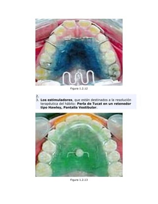 Figura 1.2.12
2.
3. Los estimuladores, que están destinados a la resolución
terapéutica del hábito: Perla de Tucat en un retenedor
tipo Hawley, Pantalla Vestibular.
Figura 1.2.13
 