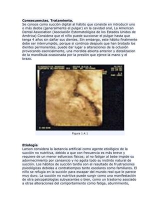 Consecuencias. Tratamiento.
Se conoce como succión digital al hábito que consiste en introducir uno
o más dedos (generalmente el pulgar) en la cavidad oral, La American
Dental Association (Asociación Estomatológica de los Estados Unidos de
América) Considera que el niño puede succionar el pulgar hasta que
tenga 4 años sin dañar sus dientes. Sin embargo, este hábito finalmente
debe ser interrumpido, porque si continúa después que han brotado los
dientes permanentes, puede dar lugar a alteraciones de la oclusión
provocando esencialmente, una mordida abierta anterior y distalizacion
de la mandíbula ocasionada por la presión que ejerce la mano y el
brazo.
Figura 1.4.1
Etiología
Larson considera la lactancia artificial como agente etiológico de la
succión no nutritiva, debido a que con frecuencia es más breve y
requiere de un menor esfuerzos físicos; al no fatigar al bebe impide su
adormecimiento por cansancio y no agota todo su instinto natural de
succión. Los hábitos de succión tardía son el resultado de frustraciones
psicológicas debidas a contratiempos tanto escolares como familiares. El
niño se refugia en la succión para escapar del mundo real que le parece
muy duro. La succión no nutritiva puede surgir como una manifestación
de otra psicopatologías subyacentes o bien, como un trastorno asociado
a otras alteraciones del comportamiento como fatiga, aburrimiento,
 