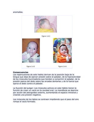 anomalías.
Consecuencias
Las repercusiones de este habito derivan de la posición baja de la
lengua que deja de ejercer presión sobre el paladar, de la hiperactividad
de los músculos buccinadores que tienden a comprimir el paladar, de la
presión pasiva del dedo sobre las arcadas dentarias y de la fuerza que
ejerce el dedo contra el paladar.
La Succión del pulgar: Los músculos activos en este hábito tienen la
función de crear un vacío en la cavidad oral. La mandíbula se deprime
por acción del pterigoideo externo, aumentando el espacio intraoral y
creando una presión negativa.
Los músculos de los labios se contraen impidiendo que el paso del aire
rompa el vacío formado.
 