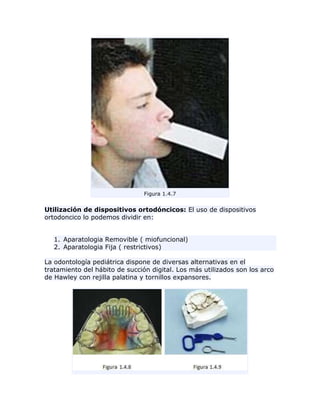 Figura 1.4.7
Utilización de dispositivos ortodóncicos: El uso de dispositivos
ortodoncico lo podemos dividir en:
1. Aparatologia Removible ( miofuncional)
2. Aparatologia Fija ( restrictivos)
La odontología pediátrica dispone de diversas alternativas en el
tratamiento del hábito de succión digital. Los más utilizados son los arco
de Hawley con rejilla palatina y tornillos expansores.
 