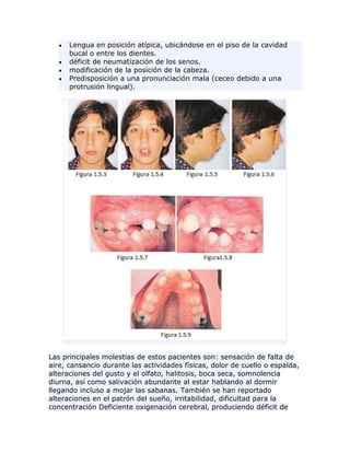 Lengua en posición atípica, ubicándose en el piso de la cavidad
bucal o entre los dientes.
déficit de neumatización de los senos.
modificación de la posición de la cabeza.
Predisposición a una pronunciación mala (ceceo debido a una
protrusión lingual).
Las principales molestias de estos pacientes son: sensación de falta de
aire, cansancio durante las actividades físicas, dolor de cuello o espalda,
alteraciones del gusto y el olfato, halitosis, boca seca, somnolencia
diurna, así como salivación abundante al estar hablando al dormir
llegando incluso a mojar las sabanas. También se han reportado
alteraciones en el patrón del sueño, irritabilidad, dificultad para la
concentración Deficiente oxigenación cerebral, produciendo déficit de
 