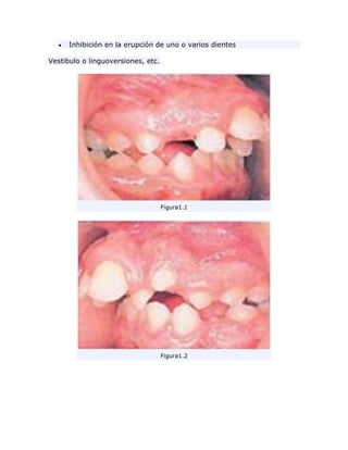 Inhibición en la erupción de uno o varios dientes
Vestibulo o linguoversiones, etc.
Figura1.1
Figura1.2
 