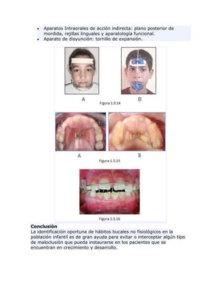 Aparatos Intraorales de acción indirecta: plano posterior de
mordida, rejillas linguales y aparatología funcional.
Aparato de disyunción: tornillo de expansión.
Conclusión
La identificación oportuna de hábitos bucales no fisiológicos en la
población infantil es de gran ayuda para evitar o interceptar algún tipo
de maloclusión que pueda instaurarse en los pacientes que se
encuentran en crecimiento y desarrollo.
 