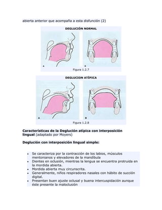 abierta anterior que acompaña a esta disfunción (2)
DEGLUCIÓN NORMAL
Figura 1.2.7
DEGLUCION ATÍPICA
Figura 1.2.8
Características de la Deglución atípica con interposición
lingual (adaptado por Moyers)
Deglución con interposición lingual simple:
Se caracteriza por la contracción de los labios, músculos
mentonianos y elevadores de la mandíbula
Dientes en oclusión, mientras la lengua se encuentra protruida en
la mordida abierta.
Mordida abierta muy circunscrita.
Generalmente, niños respiradores nasales con hábito de succión
digital.
Presentan buen ajuste oclusal y buena intercuspidación aunque
éste presente la maloclusión
 