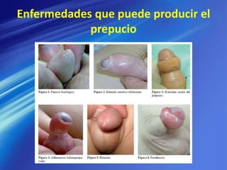 Enfermedades que puede producir el
prepucio
 