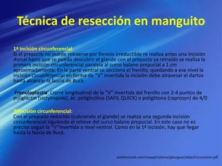 Técnica de resección en manguito
1ª incisión circunferencial:
Si el prepucio no puede retraerse por fimosis irreductible re realiza antes una incisión
dorsal hasta que se pueda descubrir el glande con el prepucio ya retraído se realiza la
primera incisión circunferencial paralela al surco balano prepucial a 1 cm
aproximadamente. En la parte ventral se secciona el frenillo, quedando a ese nivel la
incisión circunferencial en forma de “V” invertida la incisión debe atravesar el dartos
hasta alcanzar la fascia de Buck.
Frenuloplastia: Cierre longitudinal de la “V” invertida del frenillo con 2-4 puntos de
poliglactin (vicrylrapide), ác. poliglicólico (SAFIL QUICK) o poliglitona (caprosyn) de 4/0
2ªincisión circunferencial:
Con el prepucio reducido (cubriendo el glande) se realiza una segunda incisión
circunferencial siguiendo el relieve del surco balano prepucial. En este caso no es
preciso seguir la “V”invertida a nivel ventral. Como en la 1ª incisión, hay que llegar
hasta la fascia de Buck.
seattleclouds.com/myapplications/jpburgues/atlas/Circuncision.pdf
 