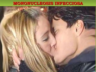 MONONUCLEOSIS INFECCIOSA 