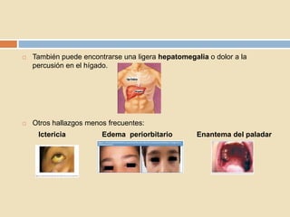  También puede encontrarse una ligera hepatomegalia o dolor a la
percusión en el hígado.
 Otros hallazgos menos frecuentes:
Ictericia Edema periorbitario Enantema del paladar
 