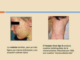 La rubéola también, pero es más
ligera con menos linfocitosis y con
erupción cutánea típica.
El herpes virus tipo 6 produce
cuadros indistinguibles de la
mononucleosis infecciosa por VEB,
son cuadros “mononucleosis-like”
 