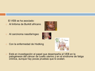 El VEB se ha asociado:
    Al linfoma de Burkitt africano


   Al carcinoma nasofaríngeo


   Con la enfermedad de Hodk...
