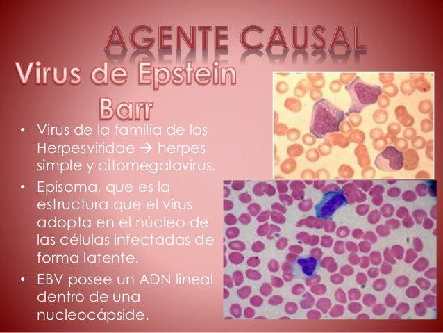 Mononucleosis infecciosa