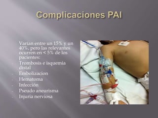 Varían entre un 15% y un
40%, pero las relevantes
ocurren en < 5% de los
pacientes:
- Trombosis e isquemia
distal
- Embolizacion
- Hematoma
- Infección
- Pseudo aneurisma
- Injuria nerviosa
 