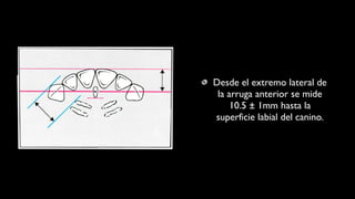 Desde el extremo lateral de
la arruga anterior se mide
10.5 ± 1mm hasta la
superficie labial del canino.
 