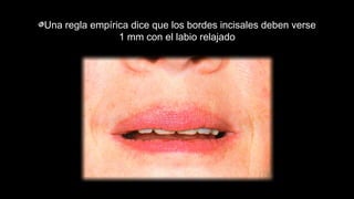 Una regla empírica dice que los bordes incisales deben verse
1 mm con el labio relajado
 
