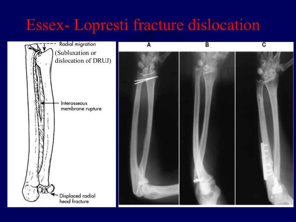 difference between monteggia and galeazzi fracture difference between monteggia and galeazzi fracture