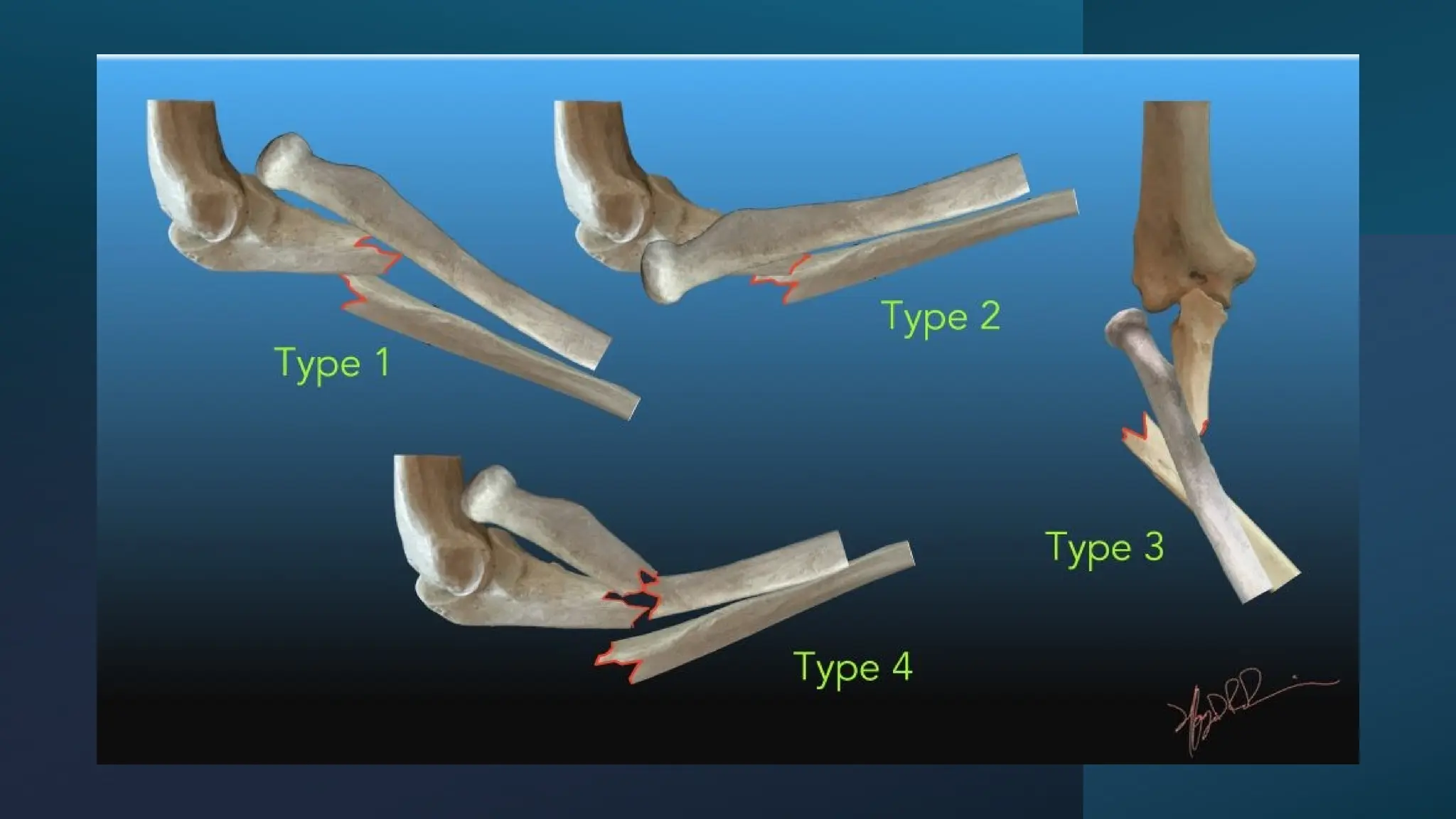 upper-limb-fractures-monteggia-fracture-pptx