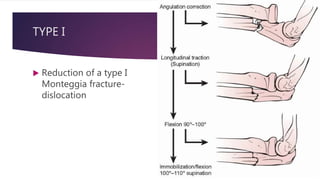 TYPE I
 Reduction of a type I
Monteggia fracture-
dislocation
 
