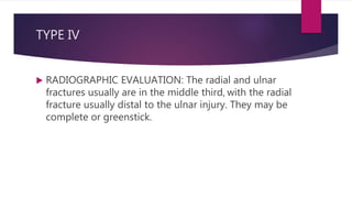 TYPE IV
 RADIOGRAPHIC EVALUATION: The radial and ulnar
fractures usually are in the middle third, with the radial
fracture usually distal to the ulnar injury. They may be
complete or greenstick.
 