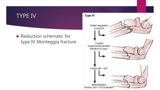 TYPE IV
 Reduction schematic for
type IV Monteggia fracture
 