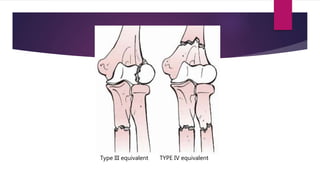 Type III equivalent TYPE IV equivalent
 