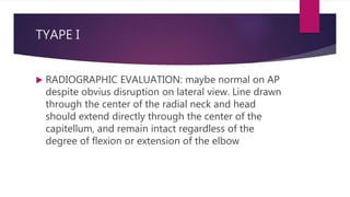 TYAPE I
 RADIOGRAPHIC EVALUATION: maybe normal on AP
despite obvius disruption on lateral view. Line drawn
through the center of the radial neck and head
should extend directly through the center of the
capitellum, and remain intact regardless of the
degree of flexion or extension of the elbow
 