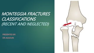 MONTEGGIA FRACTURES
CLASSIFICATIONS
(RECENT AND NEGLECTED)
PRESENTED BY:
DR AGGOUN
 