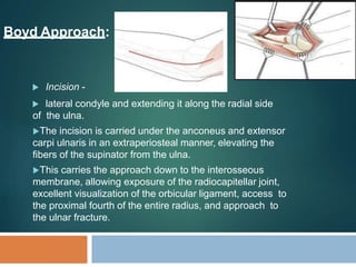 Monteggia fracture-Dislocation reference-appleys,maheshwari,rockwood | PPTX