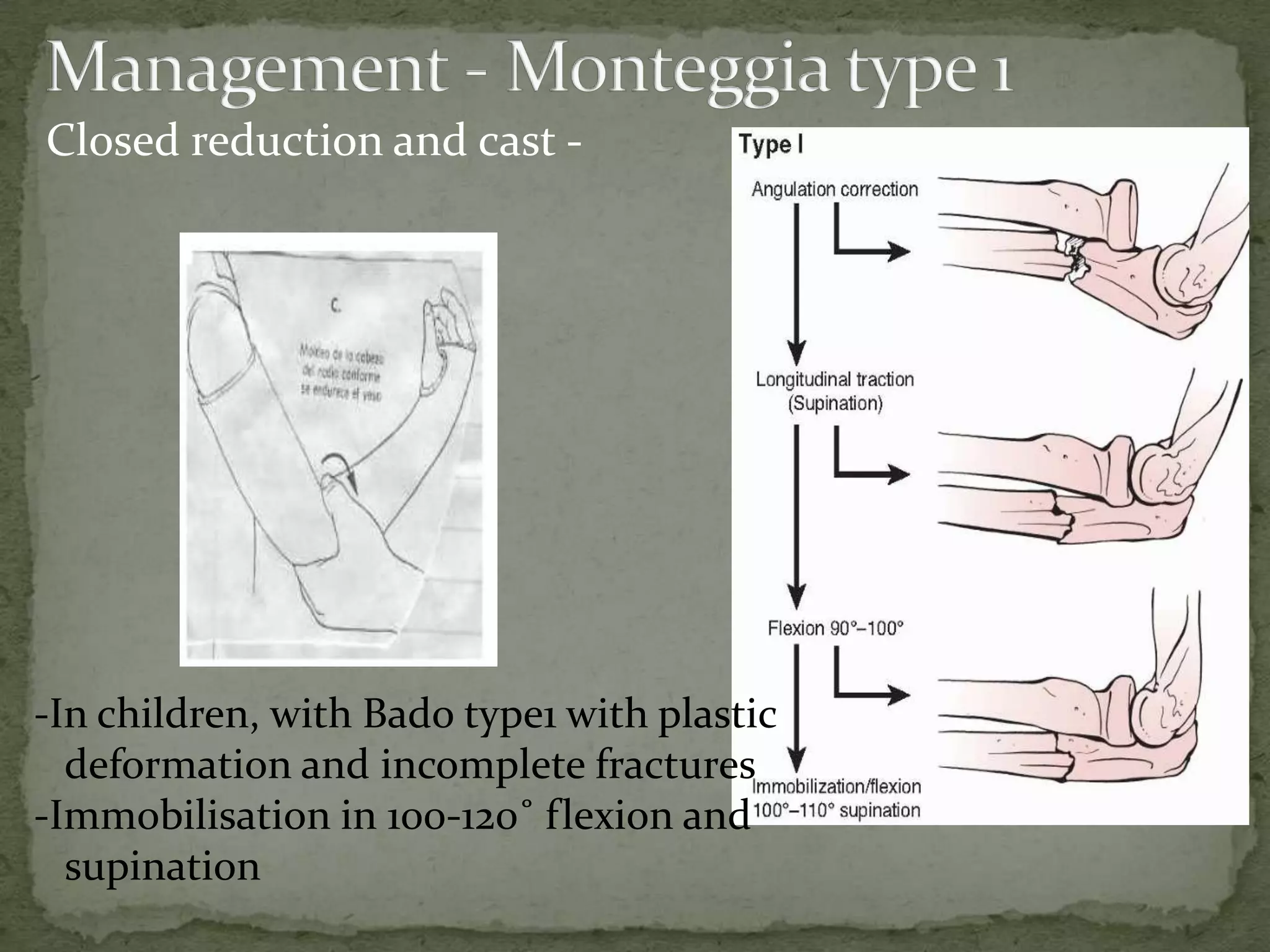Closed reduction and cast -
-In children, with Bado type1 with plastic
deformation and incomplete fractures
-Immobilisation in 100-120˚ flexion and
supination
 