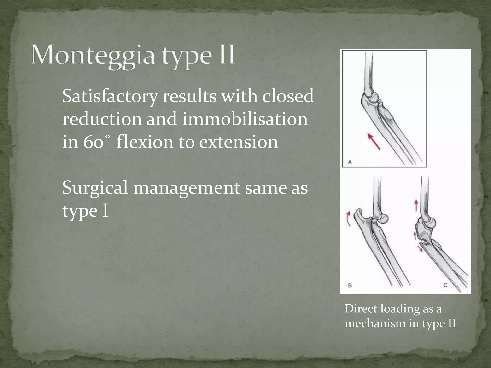 Satisfactory results with closed
reduction and immobilisation
in 60˚ flexion to extension
Surgical management same as
type I
Direct loading as a
mechanism in type II
 