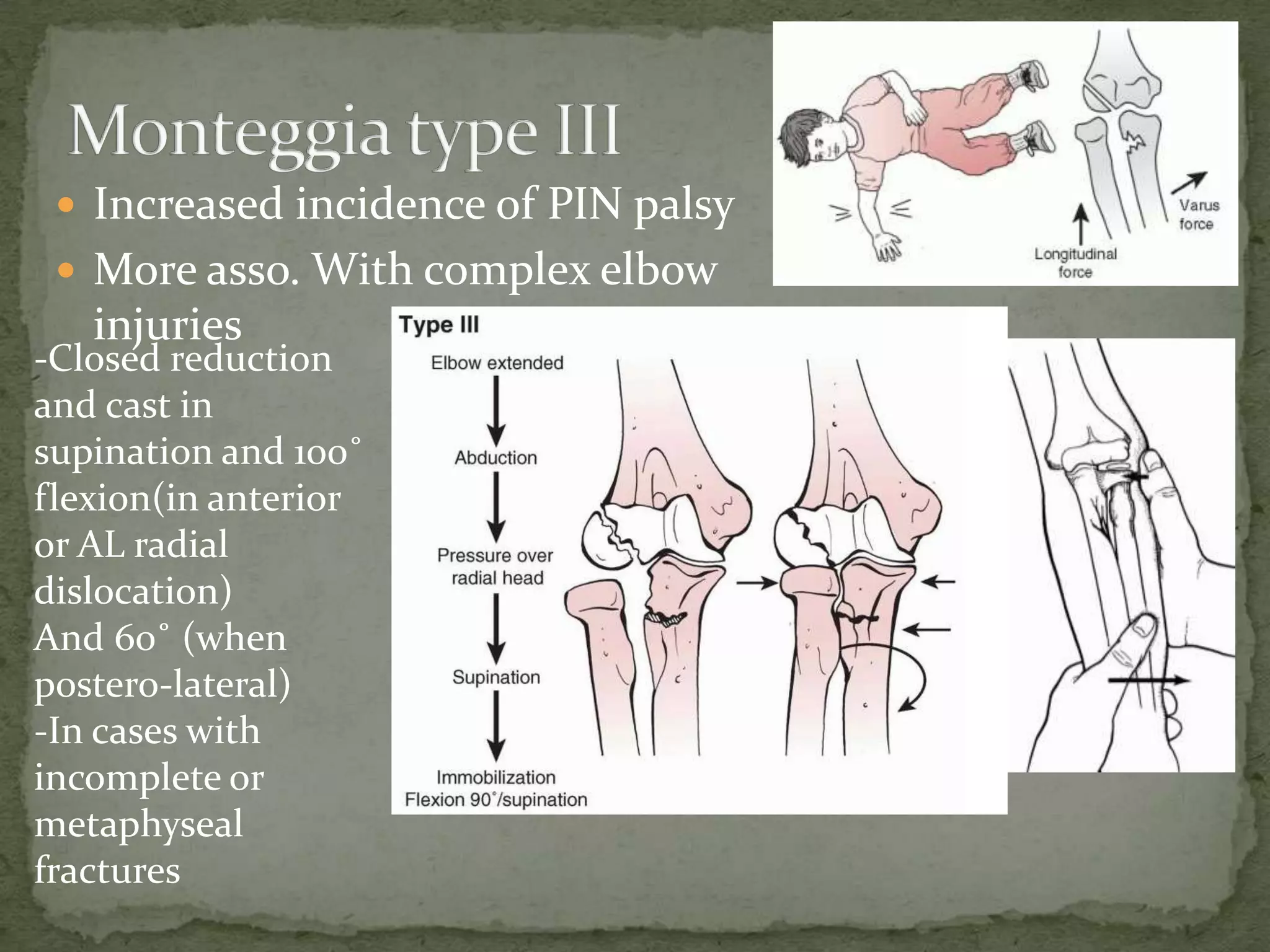  Increased incidence of PIN palsy
 More asso. With complex elbow
injuries
-Closed reduction
and cast in
supination and 100˚
flexion(in anterior
or AL radial
dislocation)
And 60˚ (when
postero-lateral)
-In cases with
incomplete or
metaphyseal
fractures
 