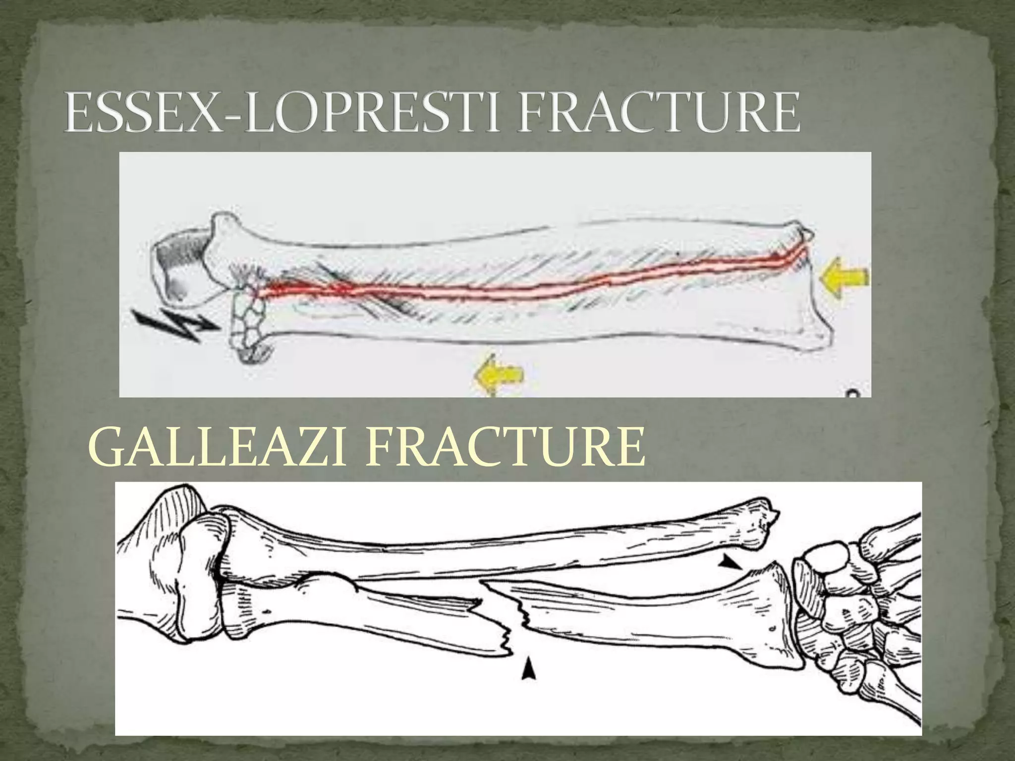 GALLEAZI FRACTURE
 