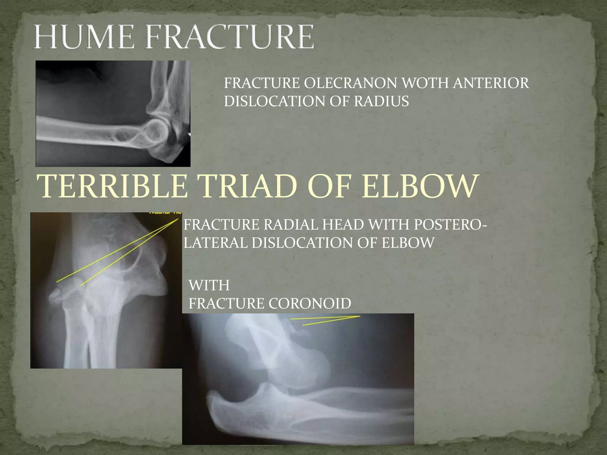 FRACTURE OLECRANON WOTH ANTERIOR
DISLOCATION OF RADIUS
TERRIBLE TRIAD OF ELBOW
FRACTURE RADIAL HEAD WITH POSTERO-
LATERAL DISLOCATION OF ELBOW
WITH
FRACTURE CORONOID
 