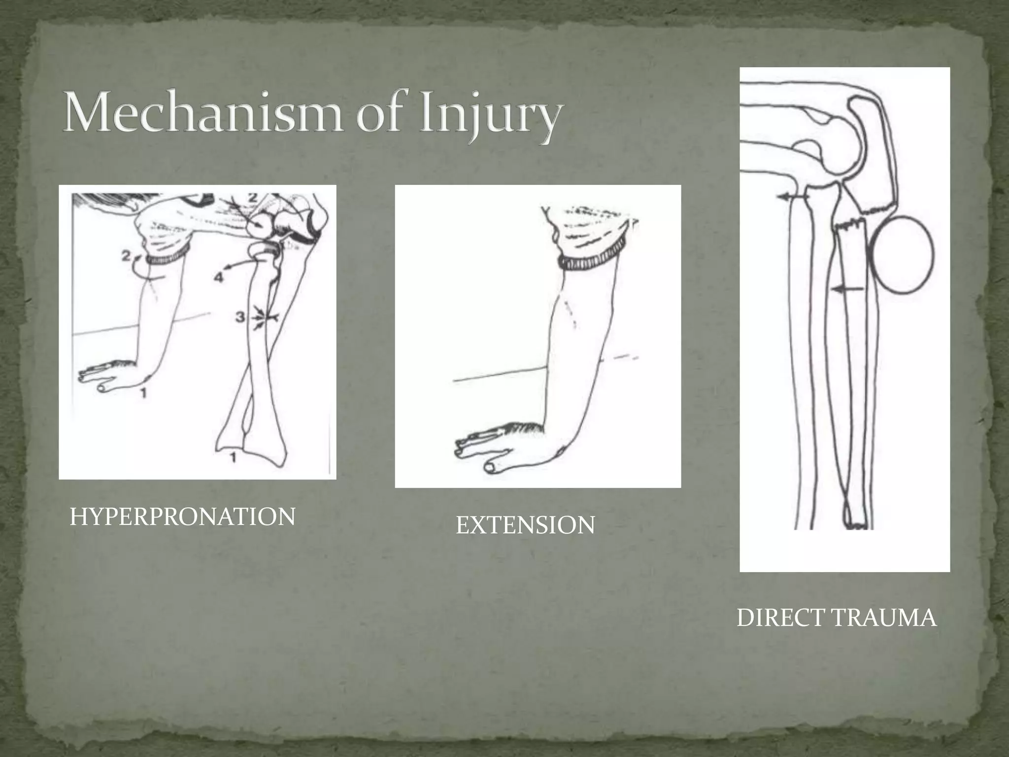 HYPERPRONATION EXTENSION
DIRECT TRAUMA
 