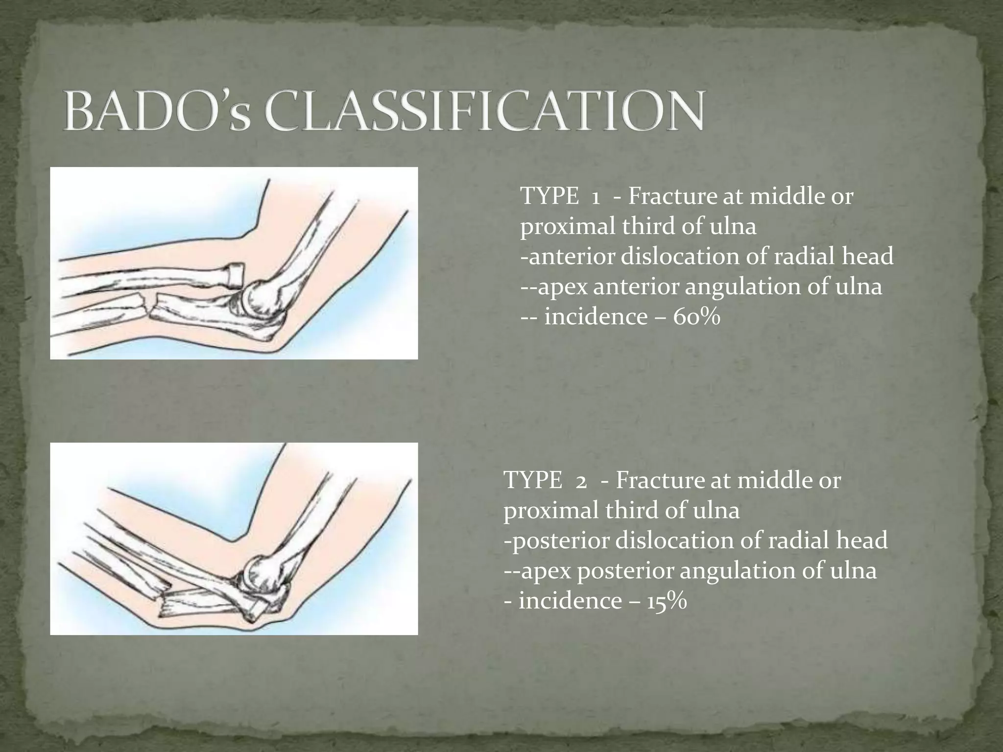 TYPE 1 - Fracture at middle or
proximal third of ulna
-anterior dislocation of radial head
--apex anterior angulation of ulna
-- incidence – 60%
TYPE 2 - Fracture at middle or
proximal third of ulna
-posterior dislocation of radial head
--apex posterior angulation of ulna
- incidence – 15%
 