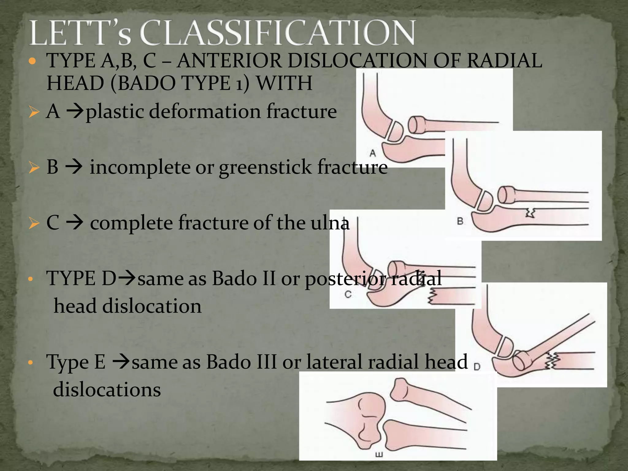 TYPE A,B, C – ANTERIOR DISLOCATION OF RADIAL
HEAD (BADO TYPE 1) WITH
 A plastic deformation fracture
 B  incomplete or greenstick fracture
 C  complete fracture of the ulna
• TYPE Dsame as Bado II or posterior radial
head dislocation
• Type E same as Bado III or lateral radial head
dislocations
 