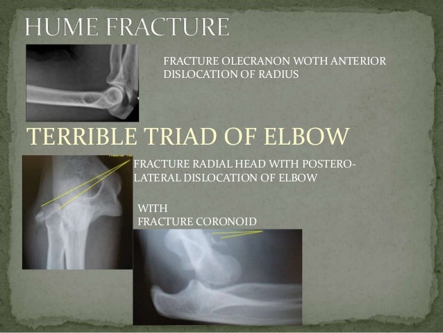 Monteggia Fracture Dislocation UTSAV