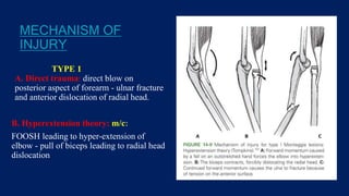 MECHANISM OF
INJURY
TYPE 1
A. Direct trauma: direct blow on
posterior aspect of forearm - ulnar fracture
and anterior dislocation of radial head.
B. Hyperextension theory: m/c:
FOOSH leading to hyper-extension of
elbow - pull of biceps leading to radial head
dislocation
 