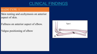 CLINICAL FINDINGS
BADO TYPE 1
Skin tenting and ecchymosis on anterior
aspect of skin.
Fullness on anterior aspect of elbow.
Valgus positioning of elbow
 