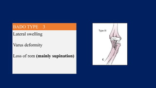 BADO TYPE 3
Lateral swelling
Varus deformity
Loss of rom (mainly supination)
 