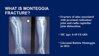 WHAT IS MONTEGGIA
FRACTURE?
• Fracture of ulna associated
with proximal radioulnar
joint and radio capitellar
joint dislocation.
• MC age: 4-10 YEARS
• Giovanni Batista Monteggia
in 1814
 